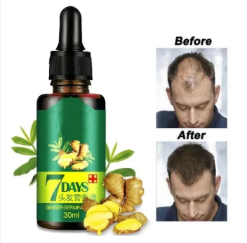 7 Days Hair Growth serum with Derma Roller With 540 Micro Needle Skin Therapy 0.50mm Natural Hair Treatment Effective Fast Growth Hair Care